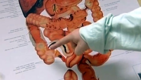 Trápi vás NADMERNÁ PLYNATOSŤ? Môže byť príznakom až 8 chorôb postihujúcich črevá!