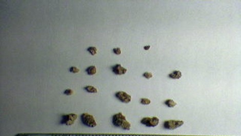 Obličkové kamene: Upozorniť vás môže ostrá bolesť v dolnej časti chrbta