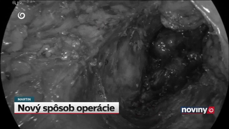 Nový spôsob operácie