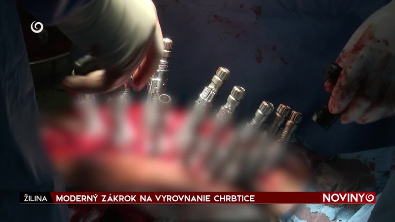 MODERNÝ ZÁKROK NA VYROVNANIE CHRBTICE