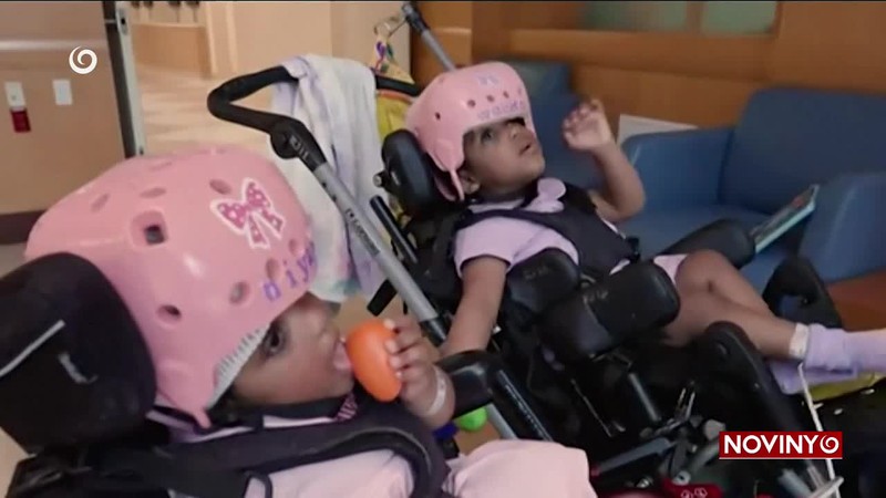 ODDELILI DVOJČATÁ ZRASTENÉ HLAVAMI