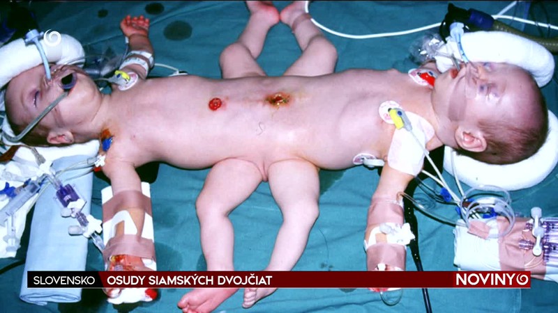 OSUDY SIAMSKÝCH DVOJČIAT