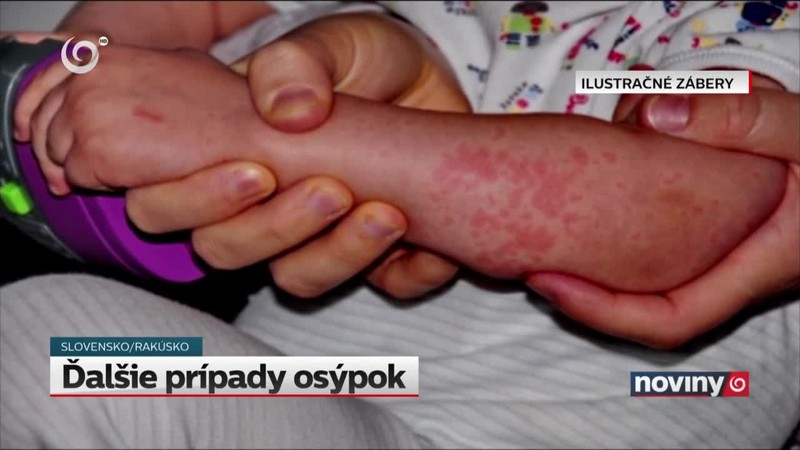 Ďalšie prípady osýpok