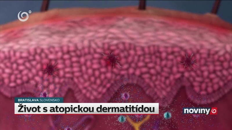 Život s atopickou dermatitídou