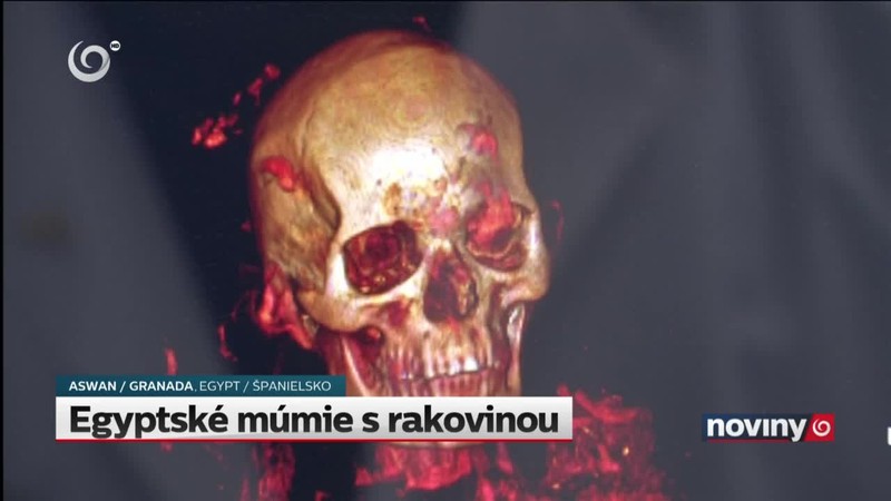 Egyptské múmie s rakovinou