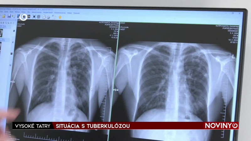 SITUÁCIA S TUBERKULÓZOU