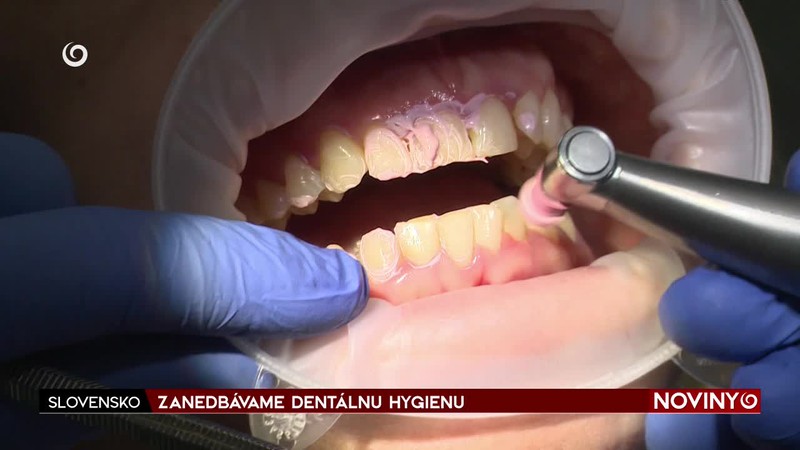 ZANEDBÁVAME DENTÁLNU HYGIENU