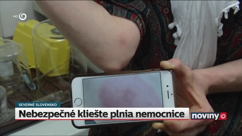 Nebezpečné kliešte plnia nemocnice
