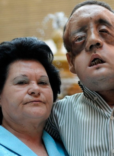 Španiel Rafael transplantácia tvár 2