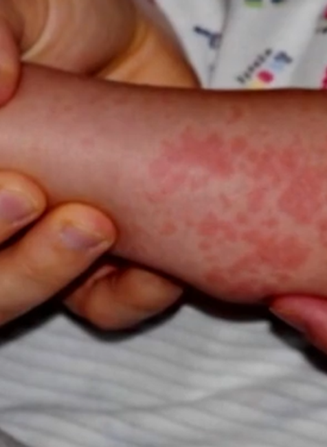 trescia pecen osypky liecba