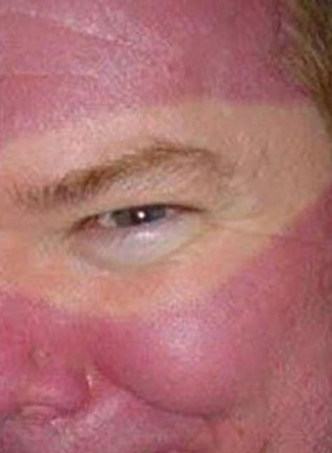 Nepodarené opálenie