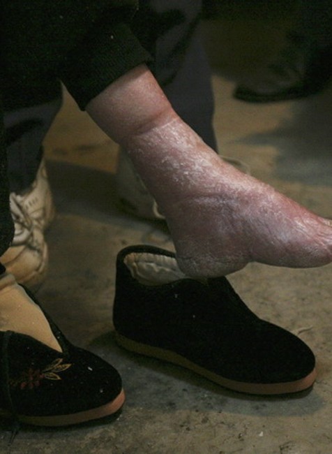 zenska cinska zdeformovana noha naha