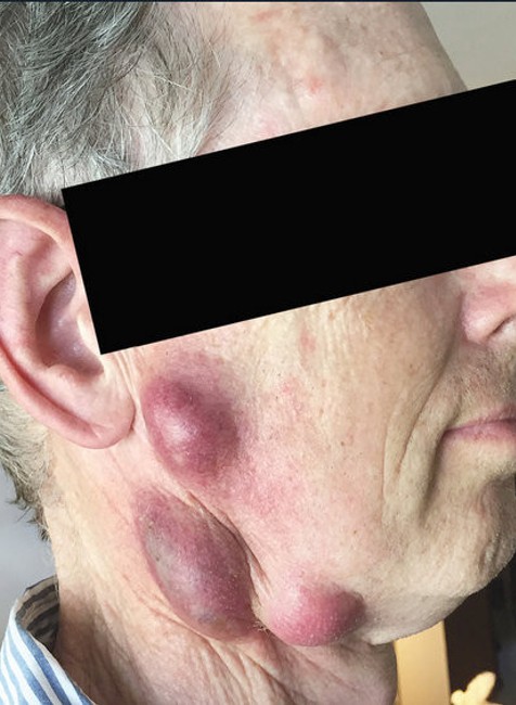 Obrovské vredy na tvári