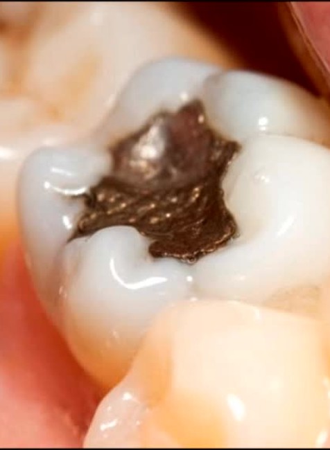 Koniec amalgámovým plombám. Od 1. júla sa čierne výplne začnú vytrácať z ordinácií