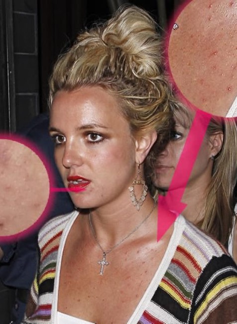 Britney Spears nemala nikdy dokonalú pleť, no v určitom obdobie jej života, to bola ozajstná pohroma. Keď sa Britney pred pár rokmi zrútila a chodila z jednej párty na druhú, akosi pozabudla, že má vyzerať ako superhviezda