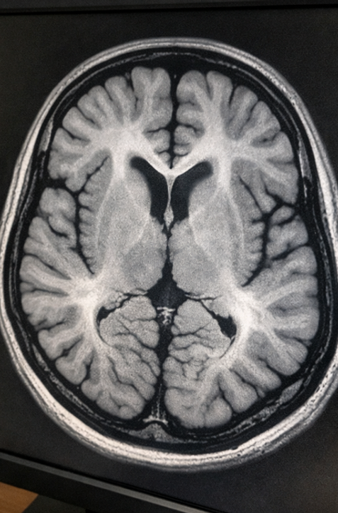 Existujú dôkazy: Koronavírus mení mozog