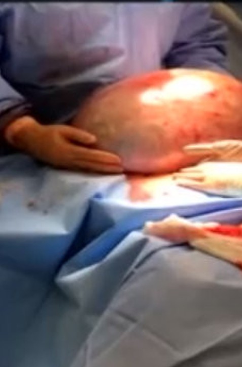 Kde všade V TELE môžete mať CYSTU? Nemusíte o nich ani vedieť