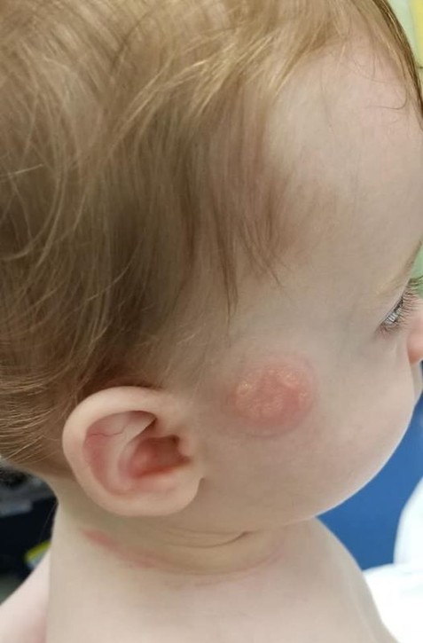 Odborník na popáleniny: Nikdy nevarte s dieťaťom na rukách