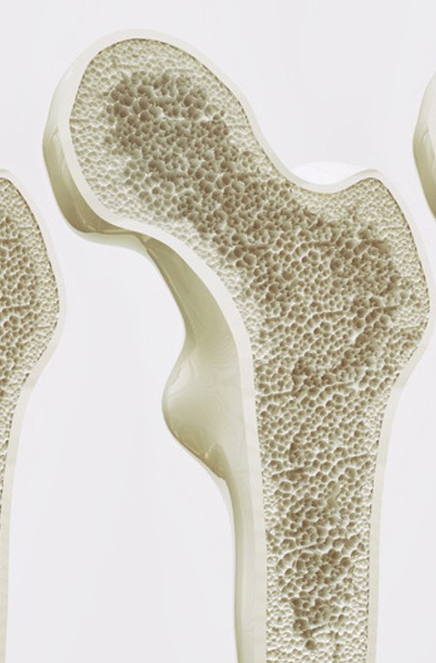 Osteoporóza je detská choroba,ktorá sa prejaví v dospelosti: Ako sa lieči?