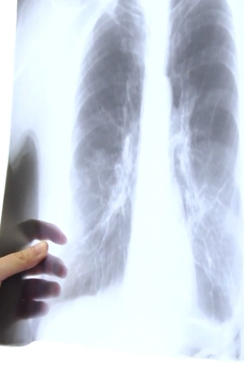 Revolúcia v liečbe rakoviny pľúc: Britskí vedci na zákernú chorobu chystajú vakcínu