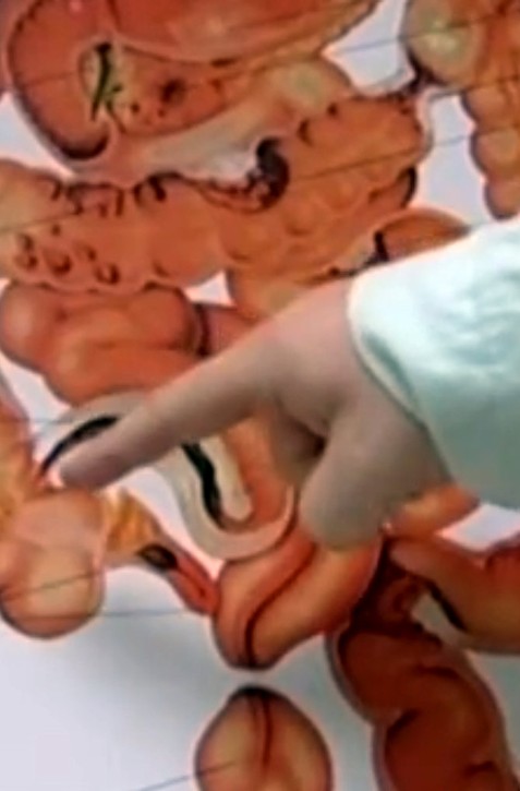 Trápi vás NADMERNÁ PLYNATOSŤ? Môže byť príznakom až 8 chorôb postihujúcich črevá!