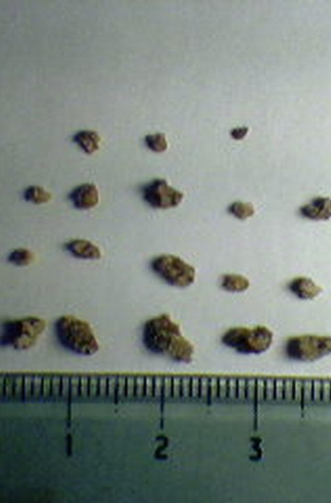 Obličkové kamene: Upozorniť vás môže ostrá bolesť v dolnej časti chrbta