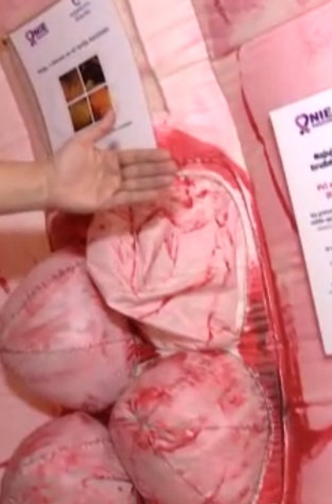 Kolonoskopia môže byť aj bezbolestná, poisťovne ju však pacientom neuhradia