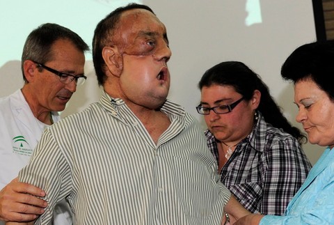 Španiel Rafael transplantácia tvár 1