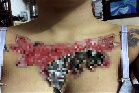 rana po odpadávajúcom tetovaní