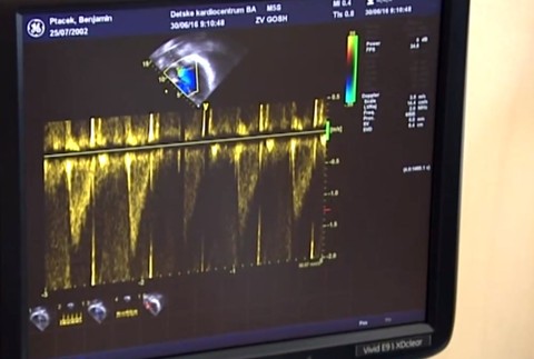 Očkovanie sa odporúča najmä ľuďom s chorým srdcom.