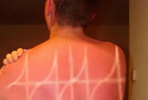 Nepodarené opálenie