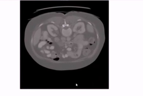 Mladý vedec zachraňuje životy. Má len 13 rokov a už vie ako pomôcť pri liečbe rakoviny