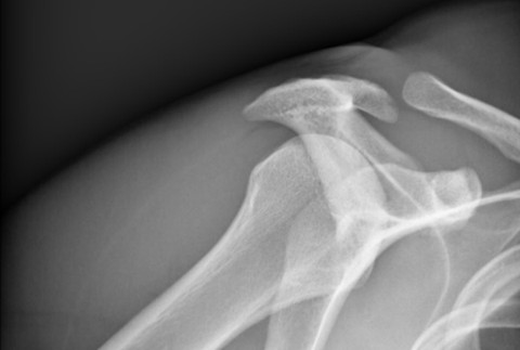 Close call and nasty crash a few weeks ago.A few injuries and fractures, but I’m glad I slept in (3)