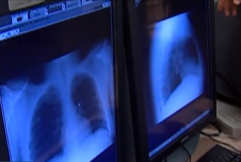 Hrozí nám pandémia rakoviny?