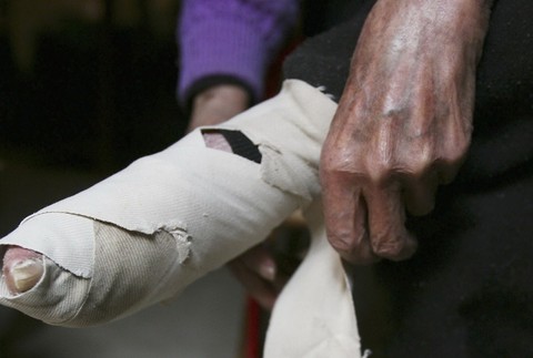 cast holej nohy v obvazoch, cina, deformacia