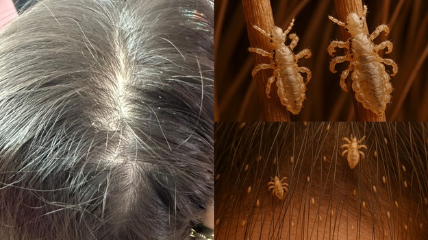 VŠI u detí? Žiadna dráma! TAKTO ich doma ZLIKVIDUJETE rýchlo a BEZ STRESU!