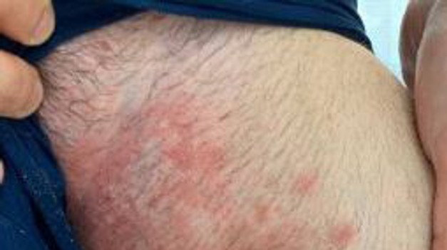 Európu trápi superpleseň, ktorá odoláva liečbe : Pozor na tieto príznaky!