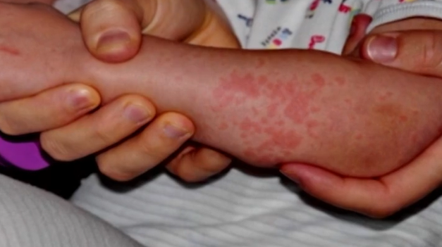 Očkovanosť proti osýpkam klesla. Odborníci upokojujú, že vakcína je bezpečná