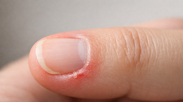 Zádery na prstoch nie sú len kozmetický problém: Prečo vznikajú a ako sa ich zbaviť?