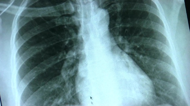 NENÁPADNÝ ZABIJAK:  Rakovinu pľúc ľudia často považujú za pretrvávajúcu infekciu