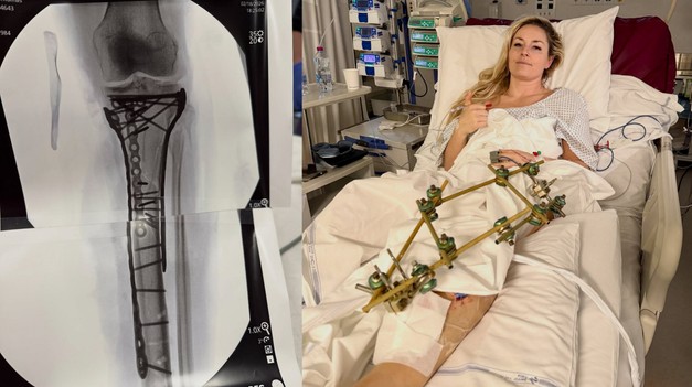 Hrozila mi amputácia, potvrdila Lindsey VONN
