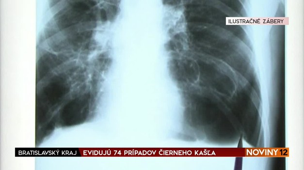 Keď rastie nádor pľúc, objavuje sa okrem kašľa aj iných 9 nečakaných príznakov. Onkologička ich popísala