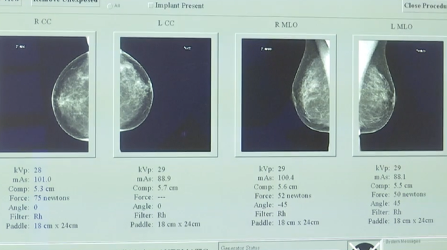 Vedci našli možný kľúč, ako zablokovať rakovinu prsníka ešte pred nádorom