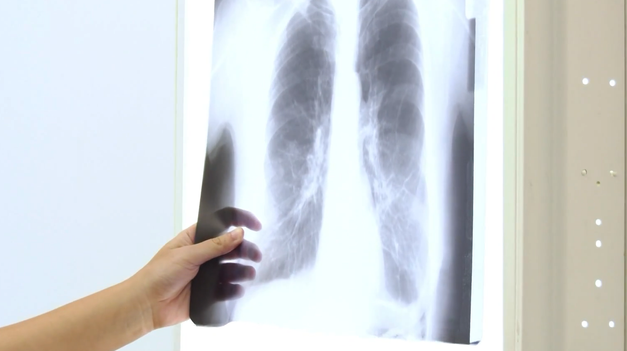 Pľúcna embolía: Zákerný stav, ktorý je náročné zistiť