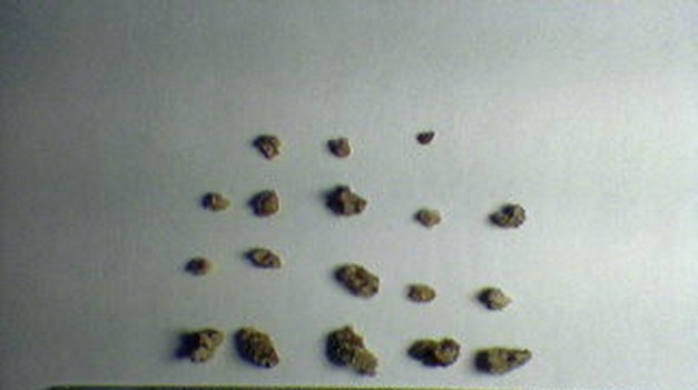 Najhoršia bolesť: 7 spôsobov, ako sa vyhnúť obličkovým kameňom