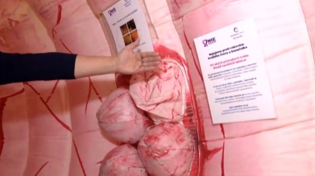 Slováci a rakovina hrubého čreva: Milujeme ultraspracované mäso, tvrdí známy lekár