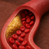 Vysoký cholesterol nebolí: Môže však spôsobiť infarkt aj mozgovú príhodu