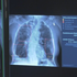 Umelá inteligencia pomáha lekárom: Automaticky zvýrazňuje diagnózy na röntgene