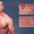 13 každodenných tipov na ľahší život s ekzémom: Čo robiť, aby koža tak nesvrbela?