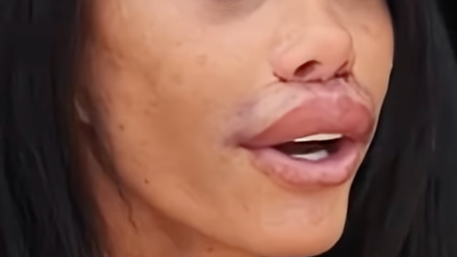 Katie Price po operácii